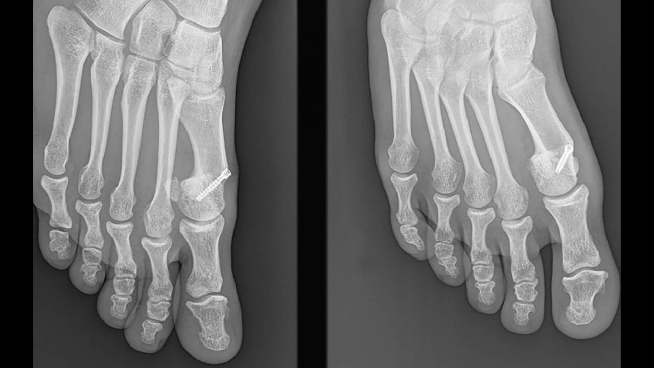 orthopaede-wien-hallux-002.jpg